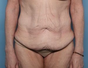 before tummy tuck female patient front view case 2970