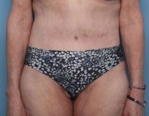 after tummy tuck female patient front view case 2970