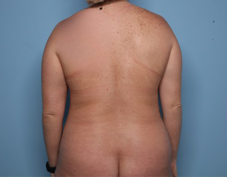 Before Allura (Laser Assisted Liposuction) back view female patient case 4512