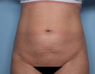 before tummy tuck front view female patient case 4500